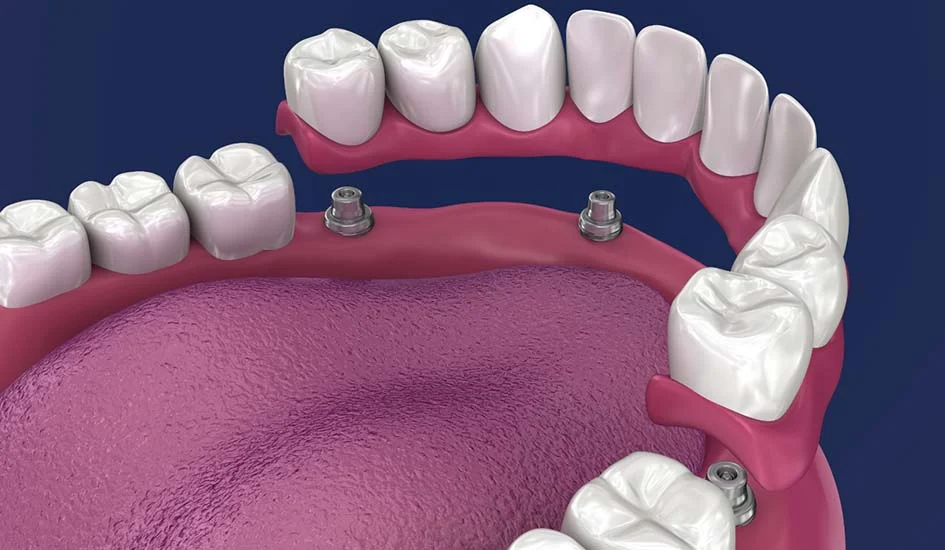 Malon bridge dental implant