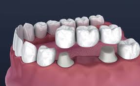 fixed dental bridges