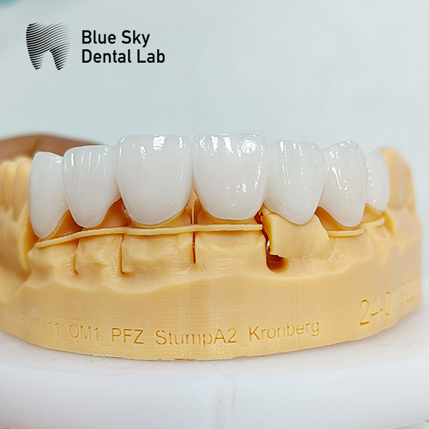zirconia full arch bridge