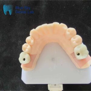 Full mouth dental implants service